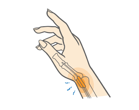 DeQuervains Tenosynovitis