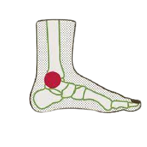 TARSAL TUNNEL SYNDROME