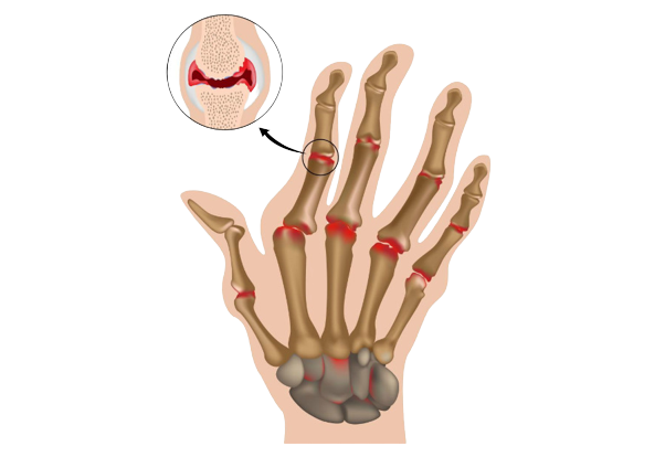 DUPUTRENS CONTRACTURE