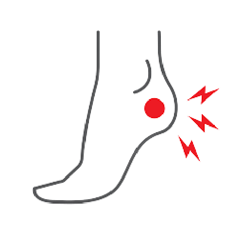 ACHILLES TENDONITIS